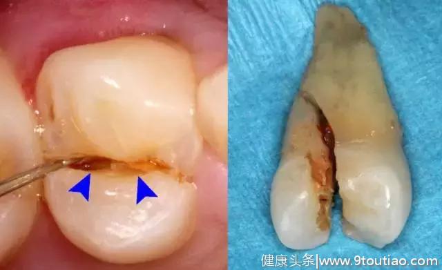 夏日千万别拿牙齿当“开瓶器”，小心劈裂