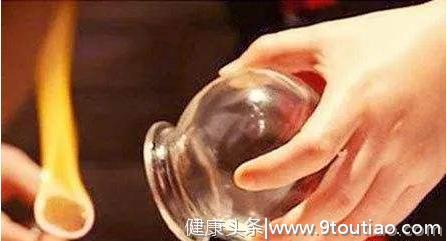 “飞鱼”菲尔普斯也爱拔火罐？拔罐的100种正确姿势，了解一下