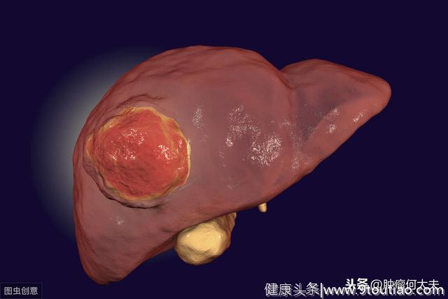 从一个肝炎到肝癌患者说起，如何阻止肝炎、预防肝癌