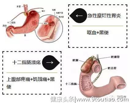 大便带血，不是痔疮就是肠癌？肛肠专家李铁民表示：没那么简单