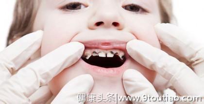 儿童蛀牙怎么治疗？