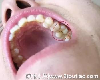 牙齿——世界上最贵的“开瓶器”#葉子口腔科普#