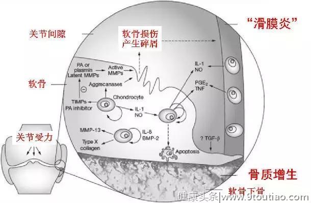 到底是“滑膜炎”，“骨质增生”，还是“关节炎”？