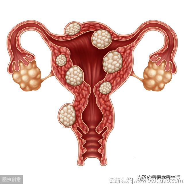 子宫肌瘤是什么？有哪些症状？会影响怀孕吗？