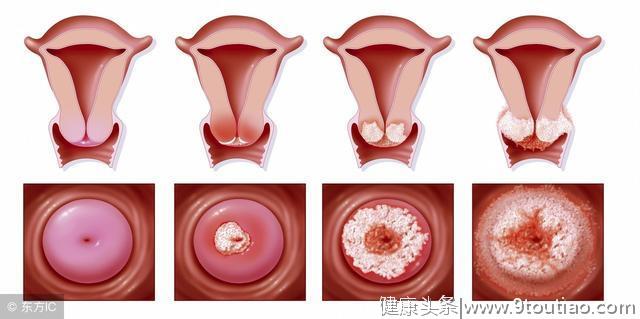 宫颈癌的症状有哪些？宫颈癌该如何做好筛查