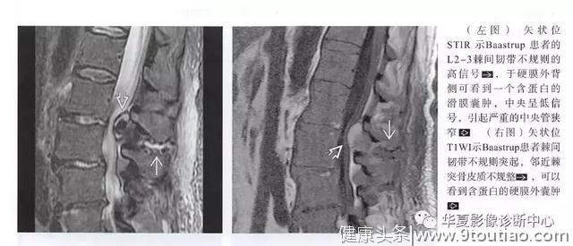 腰椎间盘扫描，除了看椎间盘，还要记得看看后面····