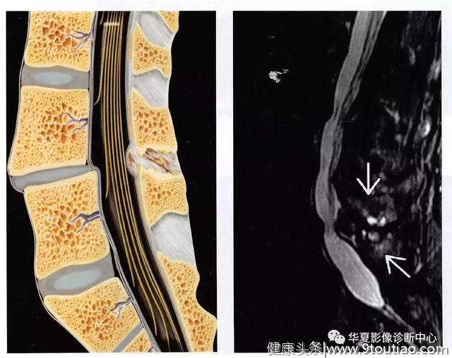 腰椎间盘扫描，除了看椎间盘，还要记得看看后面····