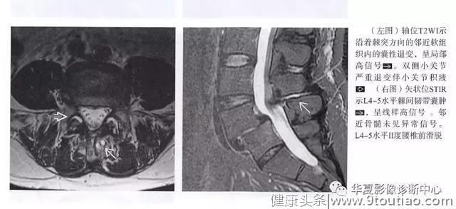 腰椎间盘扫描，除了看椎间盘，还要记得看看后面····