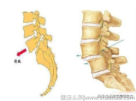 腰痛的原因有哪些？什么是核心稳定肌？很多人都搞错了