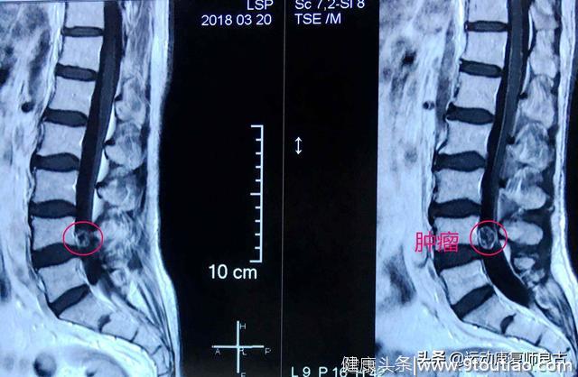 腰痛的原因有哪些？什么是核心稳定肌？很多人都搞错了