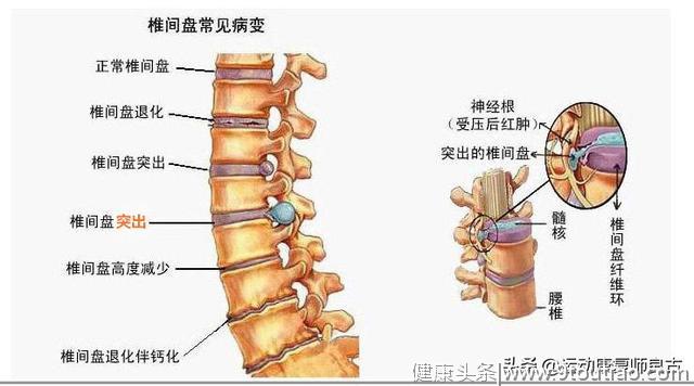 腰痛的原因有哪些？什么是核心稳定肌？很多人都搞错了