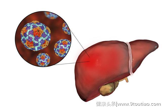 得了肝炎就一定会得肝癌？