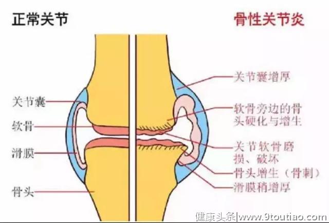 关节炎真的是冻出来的吗？