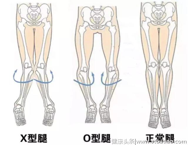 关节炎真的是冻出来的吗？