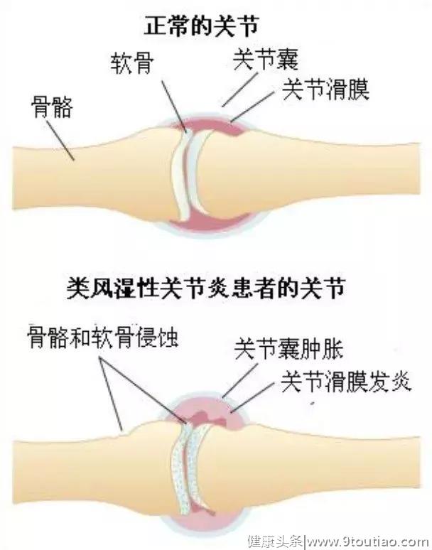 关节炎真的是冻出来的吗？