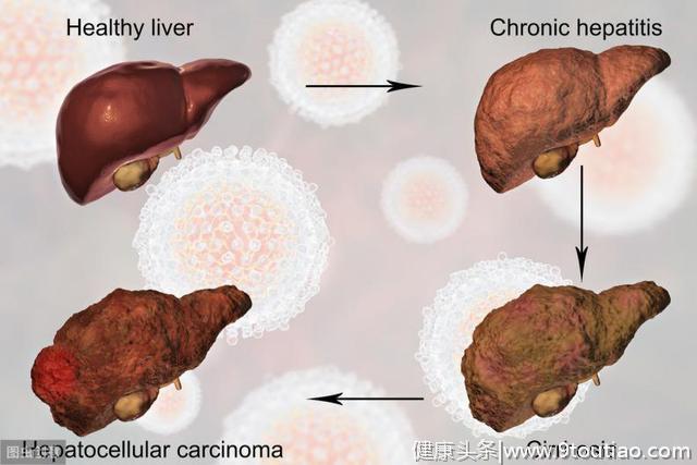 肝癌的祸根不止是酒，警示：4个因素会加速肝脏病变，尽量远离
