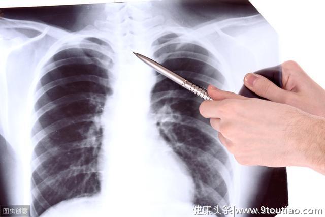 肺癌骨转移应该怎么办？这些处理方法你可知道？