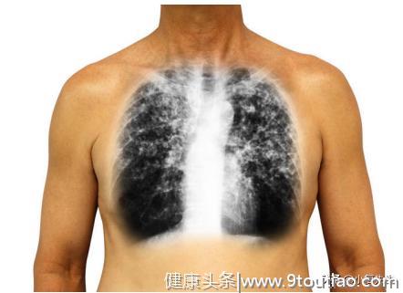 经常吸烟的人，身体出现“2疼、3黑”，多半肺癌上身，尽早检查