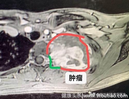 16岁女孩发现胸腔巨大肿瘤，胸腔镜手术为孩子保住胸部美观