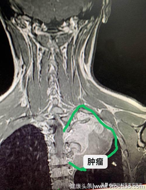 16岁女孩发现胸腔巨大肿瘤，胸腔镜手术为孩子保住胸部美观