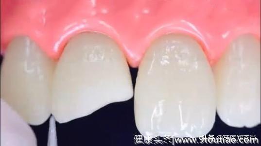 牙齿缺了一点怎么修复？有什么好的解决方法吗？