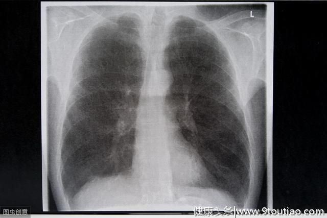 肺部CT报告上，阴影超过这个尺寸，得警惕肺癌！照这个步骤去排查