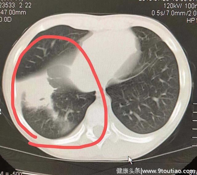 10岁男童整日待在空调房，竟因此患上肺炎