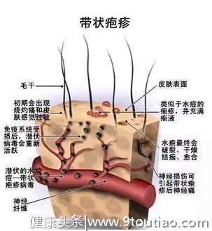 带状疱疹有多痛？痛到让你“怀疑人生”，警惕这4种情况诱发抑郁