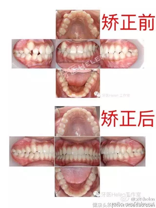 Helen齿科中心——关于隐形矫正，你真的了解吗？