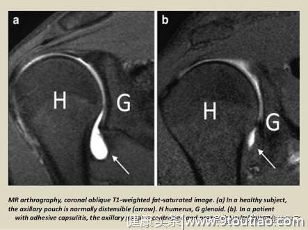 为什么肩周炎患者会有撕裂般的疼痛？怎么治才好？如何锻练？