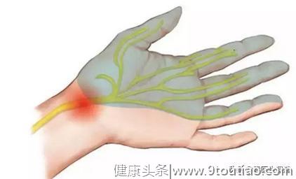 类风湿关节炎病人，上肢临床表现有哪些？医生说：有6个病变部位