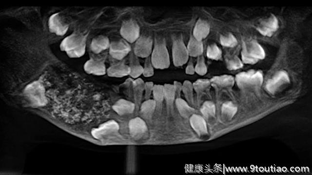 印度7岁男孩下颌肿胀送医，嘴里拔出526颗“牙齿”