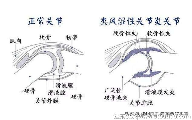 长期待在空调屋，23岁河南小伙得了类风湿，你还觉得吹空调很爽？