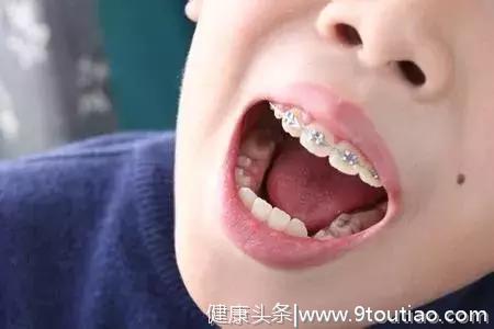 孩子有三次改变牙齿不齐的”黄金期“，爸妈千万别错过