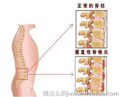 小刘说腰椎（1）-- 腰痛