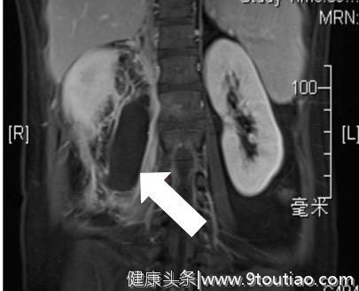 小刘说腰椎（1）-- 腰痛