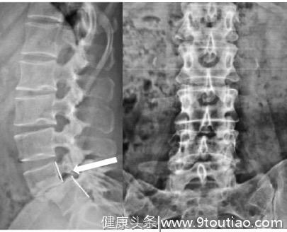 小刘说腰椎（1）-- 腰痛