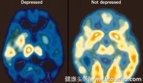科普：抑郁症病人的大脑发生了什么变化