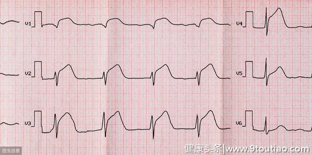 心电图和心肌酶是心肌梗死，为什么心脏造影正常？能排除心脏病？