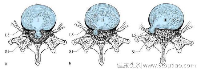 骨科医生：腰间盘突出钙化什么意思？该怎么办呢？