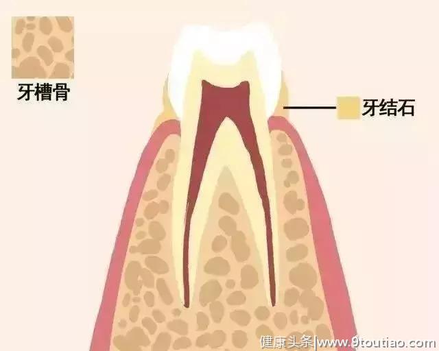 牙齿松动，一场难以避免的中年危机