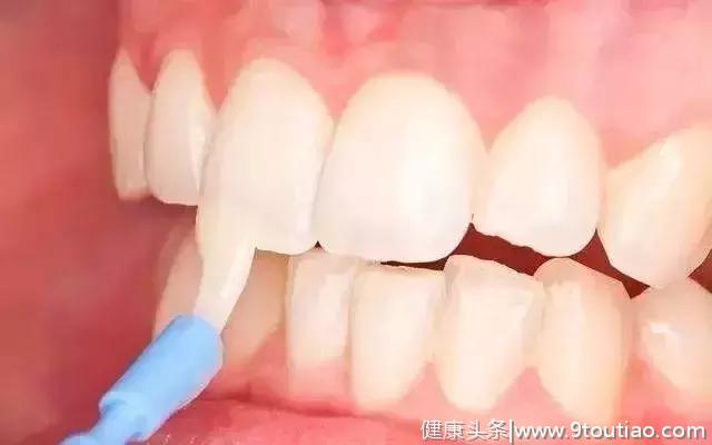 牙齿上的白线可能是氟中毒