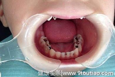 儿童乳牙出了问题需要拔除吗？等换恒牙不就好了吗？
