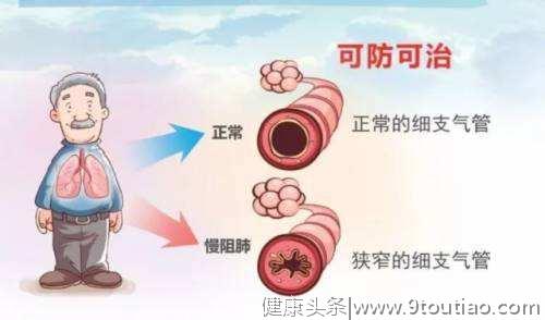 肺炎，慢阻肺患者的危险并发症