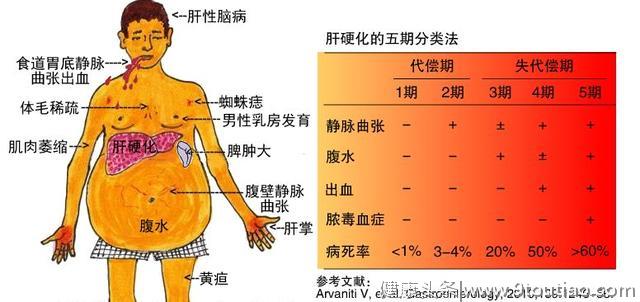 32岁男子，肝硬化入院，提醒：身上若有2红，及时就医检查