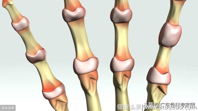 类风湿关节炎最早出现的症状是怎样的？关节疼痛需警惕