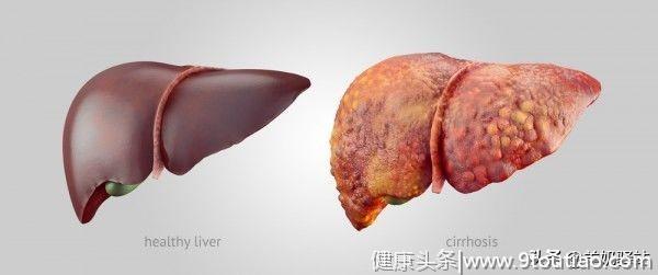权威医学杂志 Cell 最新研究：逆转脂肪肝得靠多吃肉
