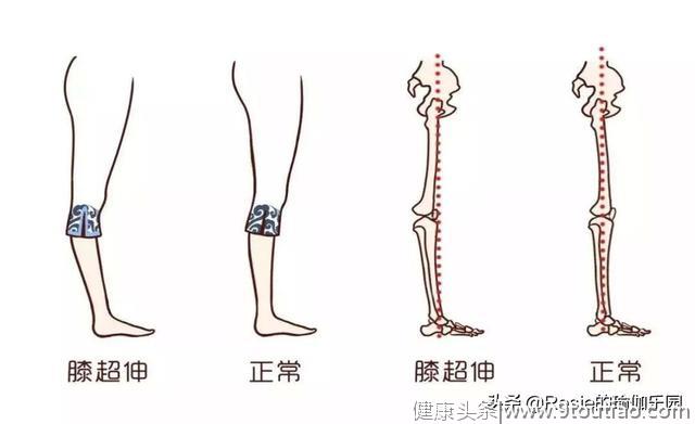 小腿粗、有青筋、肥胖纹，怎么瘦腿祛纹？哪些体式可以缓解腰痛？
