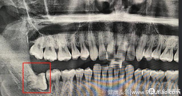 保姆级牙齿护理攻略！牙膏、智齿、科学刷牙、洗牙、牙齿美白