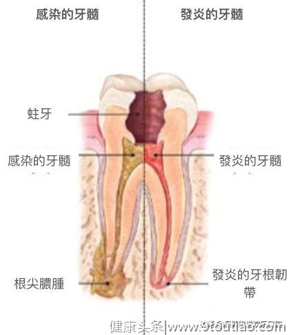 你以为蛀牙不看牙医是省钱省事？趁早补牙才是真正的省钱